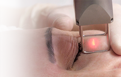 Шлифовка кожи и удаление шрамов лазером CO2