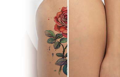 Удаление татуировок, перманентного макияжа и татуажа  PICO-секундным лазером